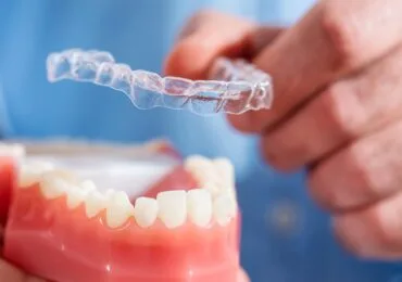 Allineatori trasparenti