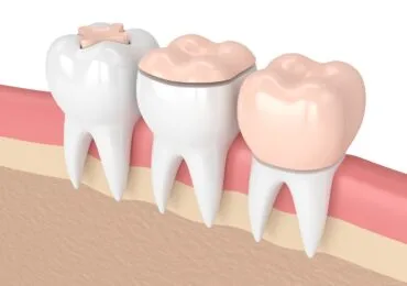 Corone in Zirconio Zucchini