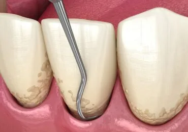 Curettage Zucchini Odontoiatra