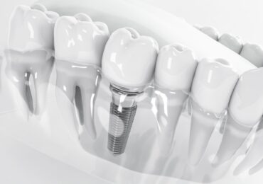 Impianto Dentale Singolo Zucchini