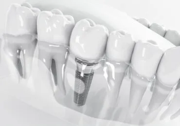 Impianto Dentale Singolo Zucchini