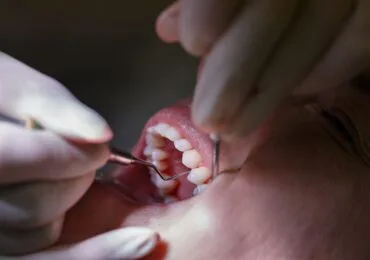 Sondaggi Parodontale presso Zucchini Odontoiatra